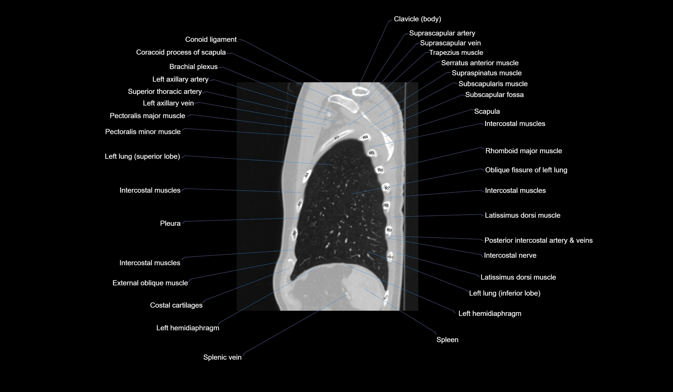 CT chest (thorax) lung window labelled sagittal cross sectional anatomy radiology image-00120.webp